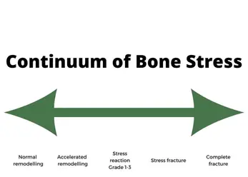 https://therunnerdoc.com/wp-content/uploads/2022/07/Continuum-of-Bone-Stress-1024x731.jpg.webp?ezimgfmt=rs:348x248/rscb1/ngcb1/notWebP