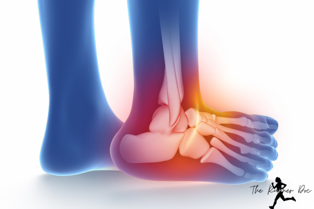 Lateral Ankle Sprains in Runners